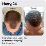 Sons Minoxidil Cutaneous Solution Reactivates